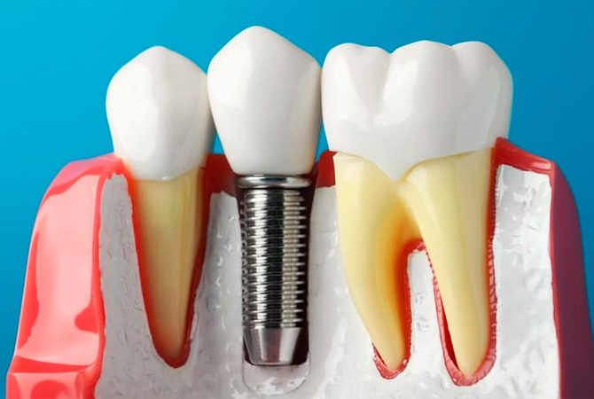 Імплантація зубів