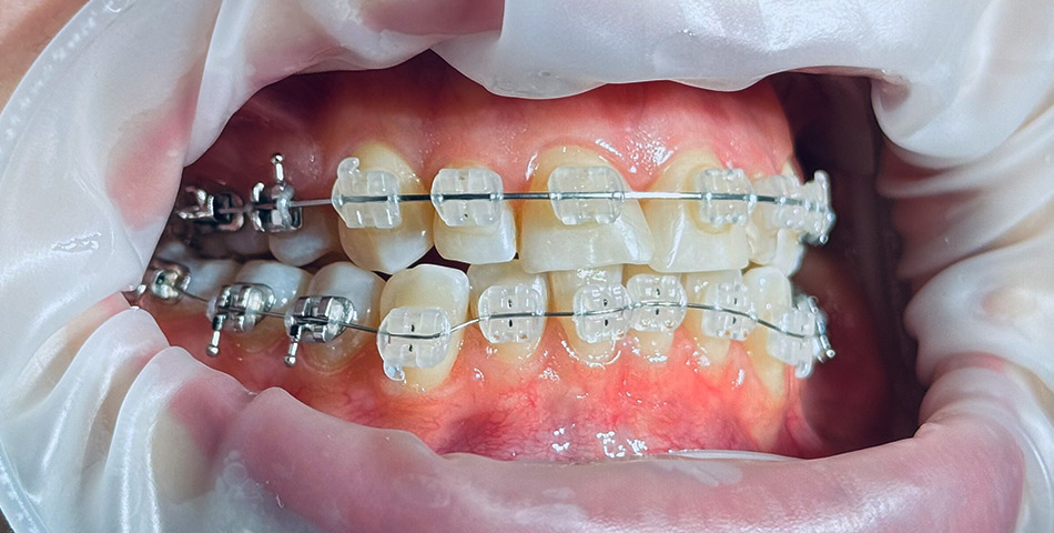 Комбіновані брекети