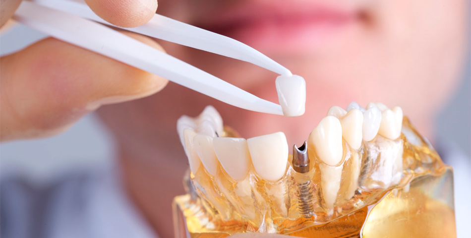 Коронки на имплантат