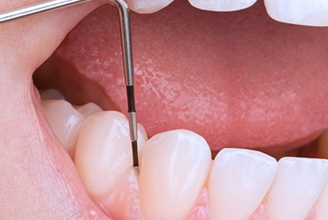 Лікування гінгівіту