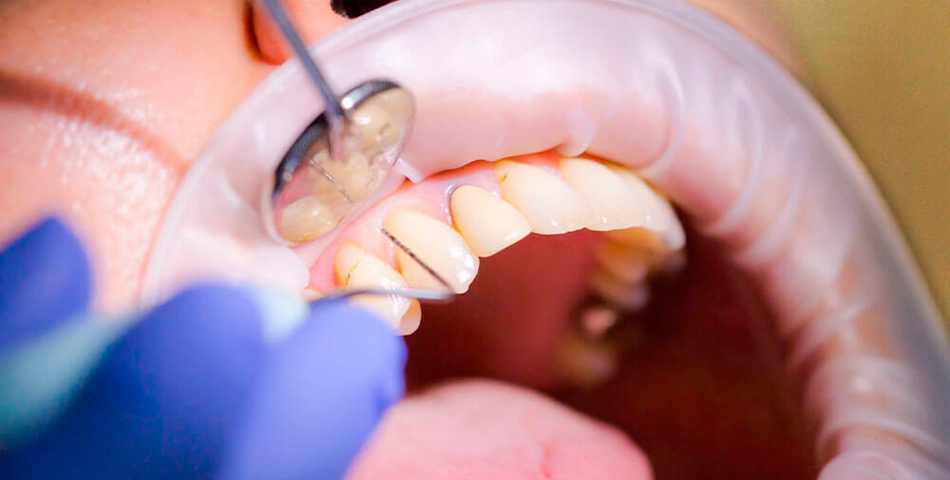 Периодонтит