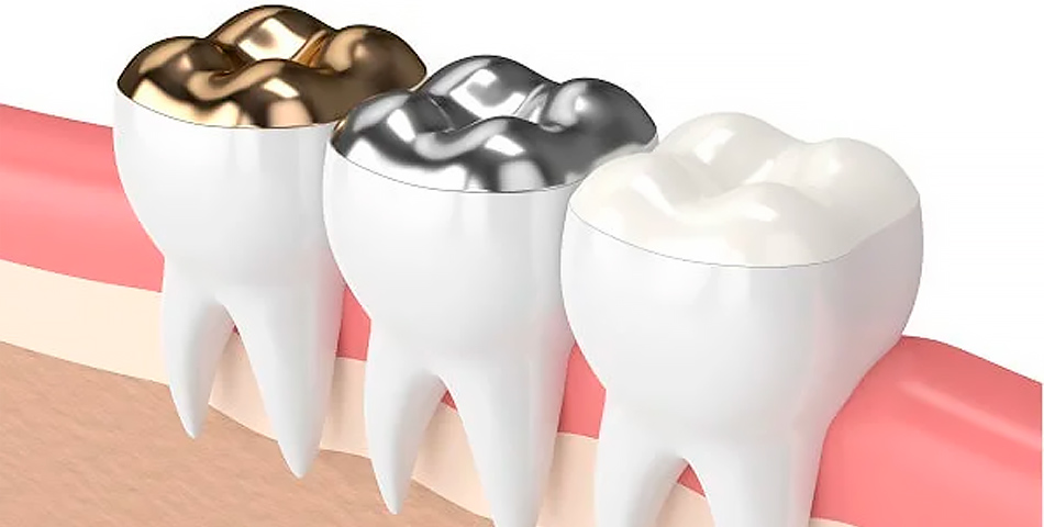 Пломба на зуб