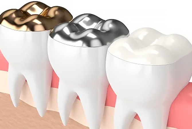 Пломбування зубів