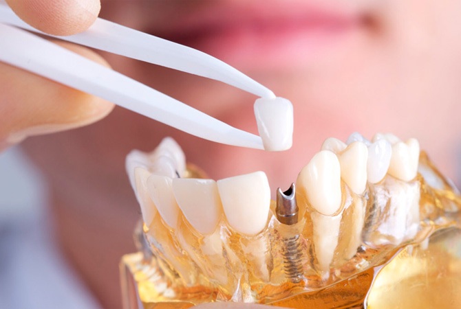 Коронки на імпланти