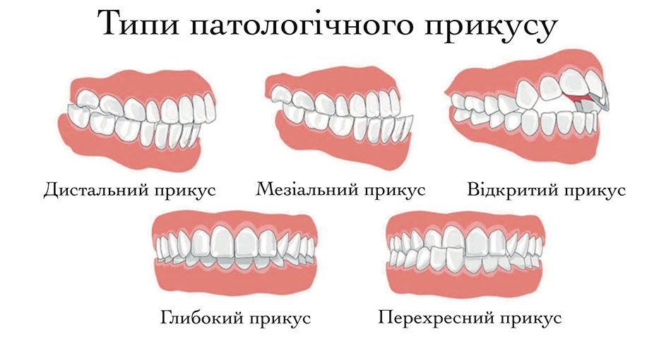 типы прикуса