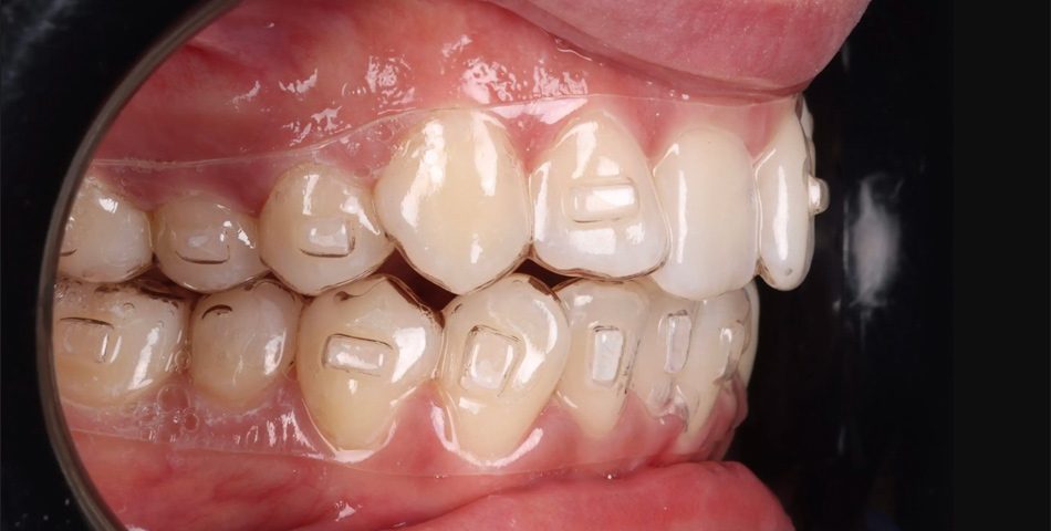 Як працюють Елайнери_